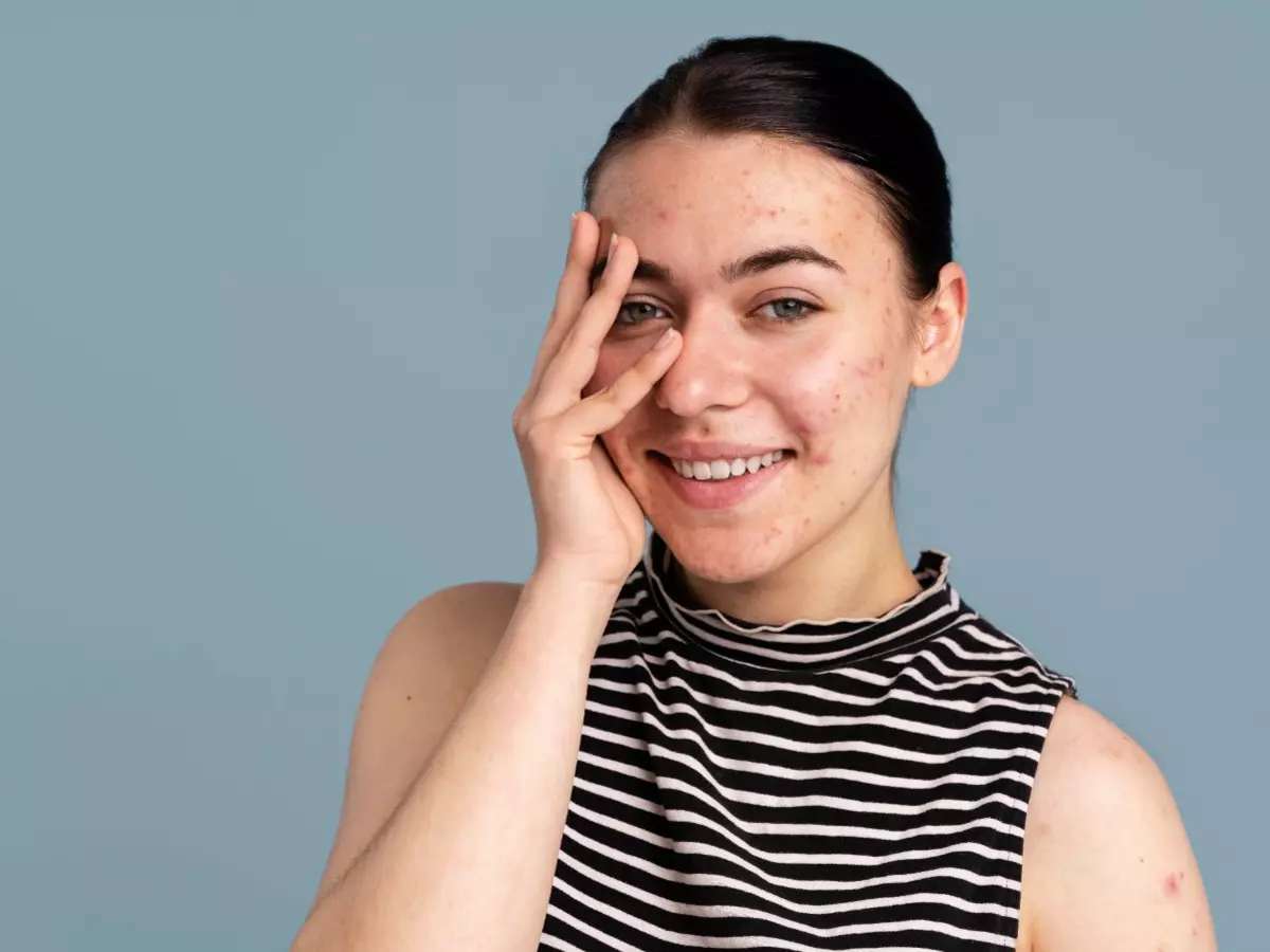 young-woman-being-confident-with-her-acne-68011225d34bf Here’s how you can get your glow back in six ways (Credit: Freepik)